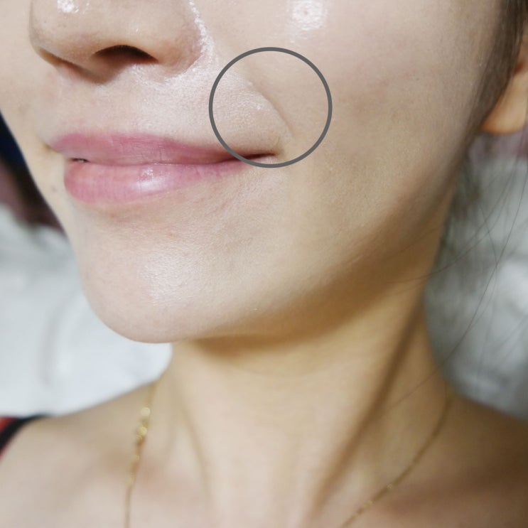  팔자주름없애기 : 30일의 변화, 이연수 팔자주름패치