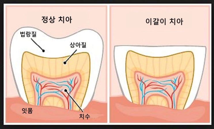 삼송역 치과 어린이 이갈이, 원인과 치료법