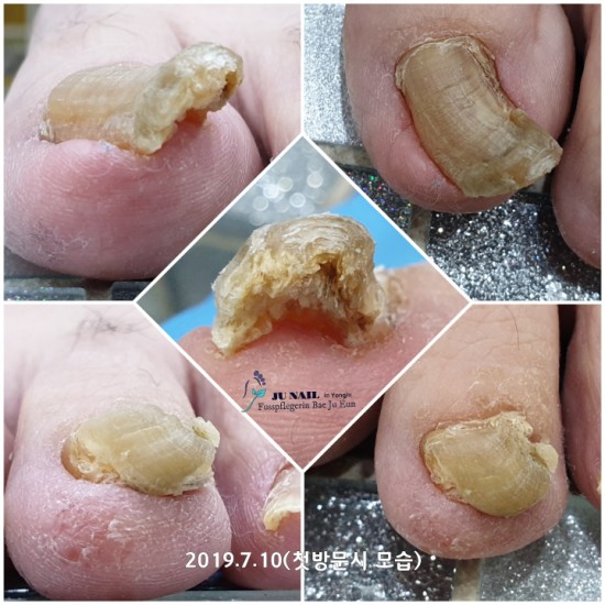 단1회의 관리로 이럴수가??무좀발톱관리의 중요성/분당용인수원수지보정동백죽전동/주네일/무좀파고드는내향성발톱전문네일샵 단1회의 관리로 이럴수가??무좀발톱관리의 중요성/분당용인수원수지보정동백죽전동/주네일/무좀파고드는내향성발톱전문네일샵
