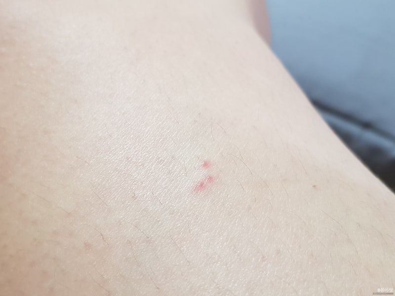 권연벌레 물림 극혐이네요. : 네이버 블로그 권연벌레 물림 극혐이네요. : 네이버 블로그