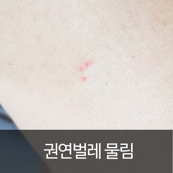 권연벌레 물림 극혐이네요. : 네이버 블로그 권연벌레 물림 극혐이네요. : 네이버 블로그