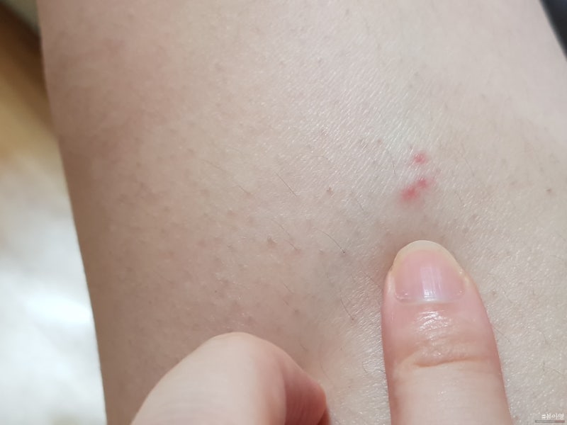 권연벌레 물림 극혐이네요. : 네이버 블로그 권연벌레 물림 극혐이네요. : 네이버 블로그