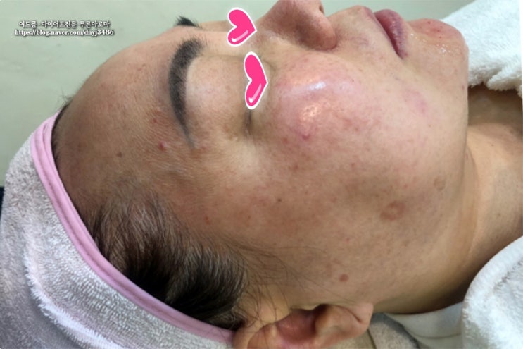  광주 주름관리 15kg 감량 후 탄력관리 중