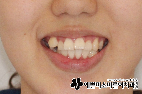  해운대교정치과, 덧니교정과 돌출입교정이 고민이라면?