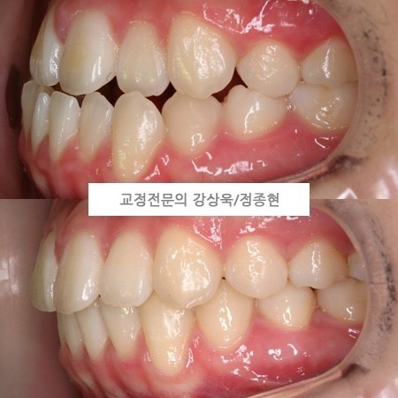 서면 정상교합치료 교정치과 정상교합을 7