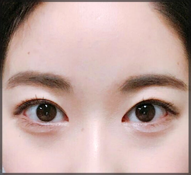  강남앞트임재건수술 부작용으로 고생하고 있다면?