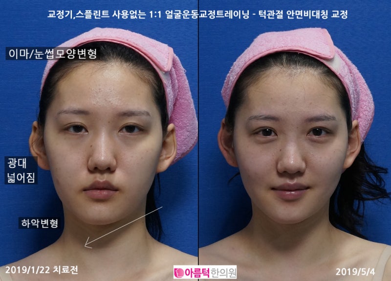 중앙부 축소, 돌출형 얼굴교정 - 턱관절 안면비대칭교정