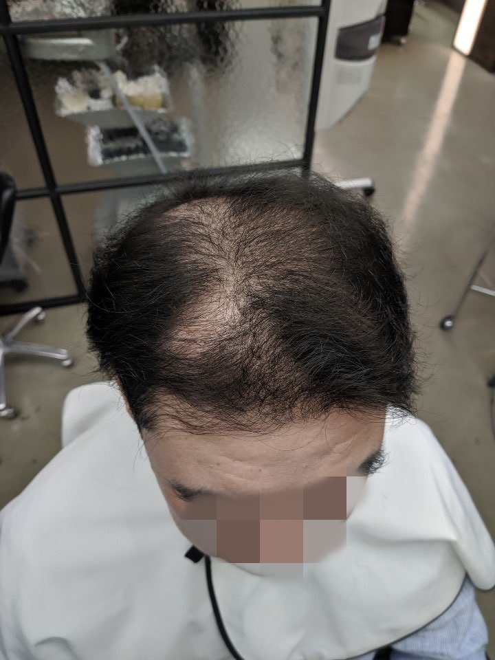  탈모머리스타일 자연스러운 헤어증모술로!