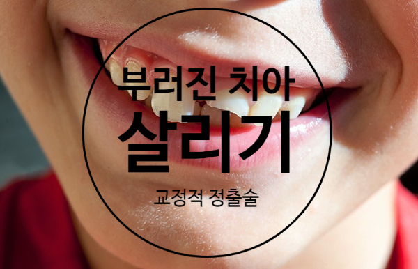 부러진치아 살리기 - 교정적 치아정출술 부러진치아 살리기 - 교정적 치아정출술