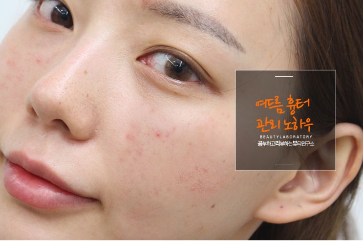  여드름 흉터 관리한 피부재생관리법