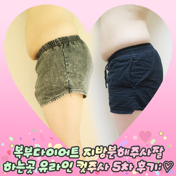  복부다이어트 지방분해주사 잘하는곳 유라인 컷주사 5차 후기: