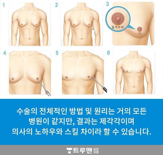 광주여유증 이제 걱정마세요