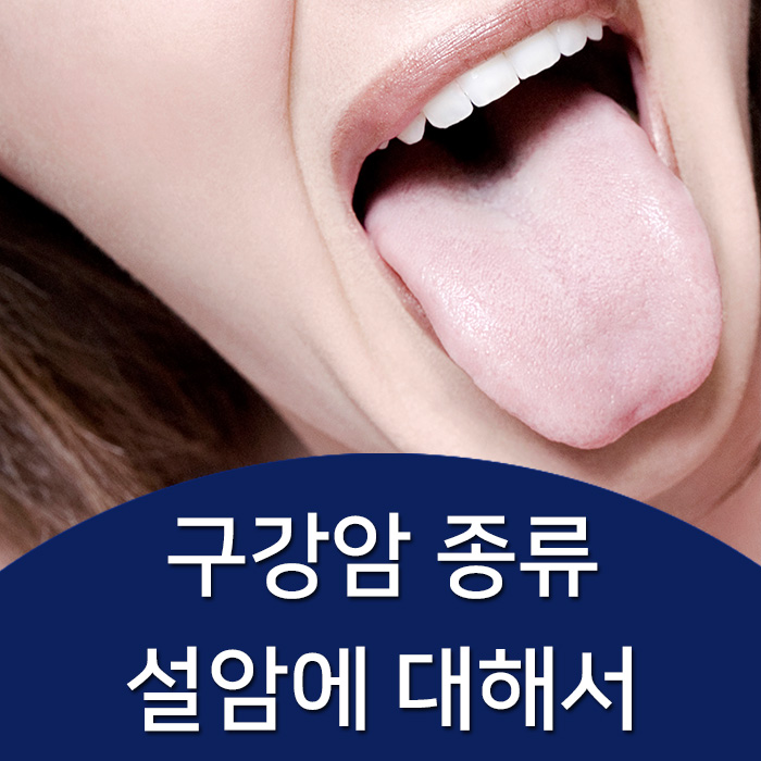  설암 증상에 대해서 알고 계시나요?