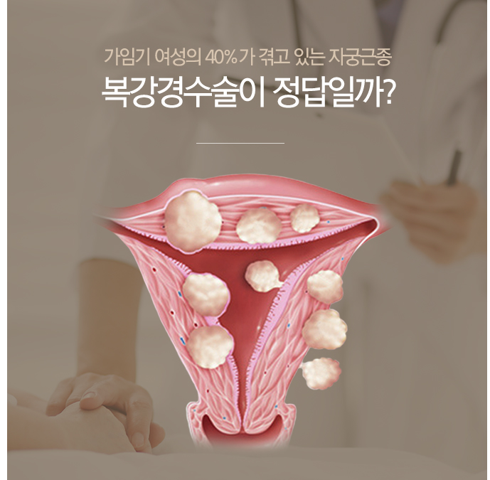  자궁근종 복강경 수술이 정답?