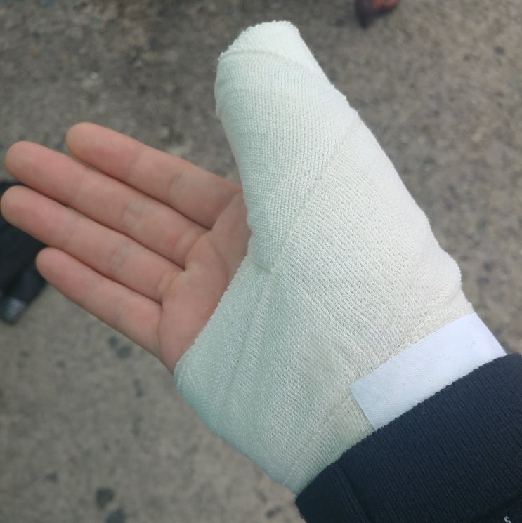  손목터널증후군 모든 것! 자가진단부터 운동까지