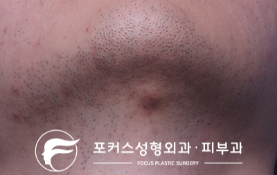  턱의 혹 - Dr. 김 칼럼