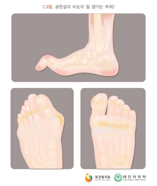 발바닥 발가락 티눈 원인 제거 치료 8