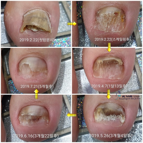 남자발톱무좀관리5개월경과/분당용인수원수지보정동백죽전동/주네일/무좀파고드는내향성발톱전문네일샵