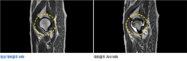  골반 통증이 완화되지 않으신다고요? <대퇴 골두 무혈성 괴사>를 의심해보세요.