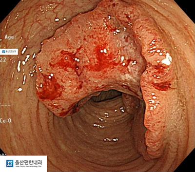  울산 대장내시경 - 대장암 검진 분변잠혈검사 양성시 대장내시경 검사에서 대장 선종 발견율이 높습니다.