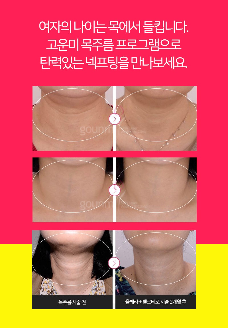 주름관리 이젠 목도 필수! | 목주름 1