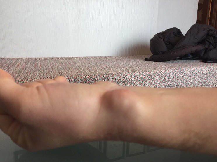  양산 365데이한의원에선 결절종을 이렇게 치료합니다!