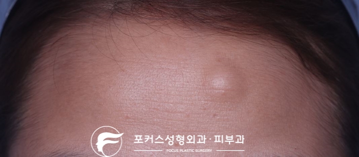  [부천성형외과 Dr. 김 칼럼] 이마의 단단한 혹