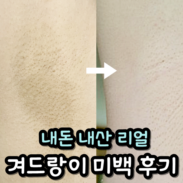  겨드랑이 색소침착 레이저 미백효과 vs 겨드랑이 미백크림? 나코 마유크림 솔직후기