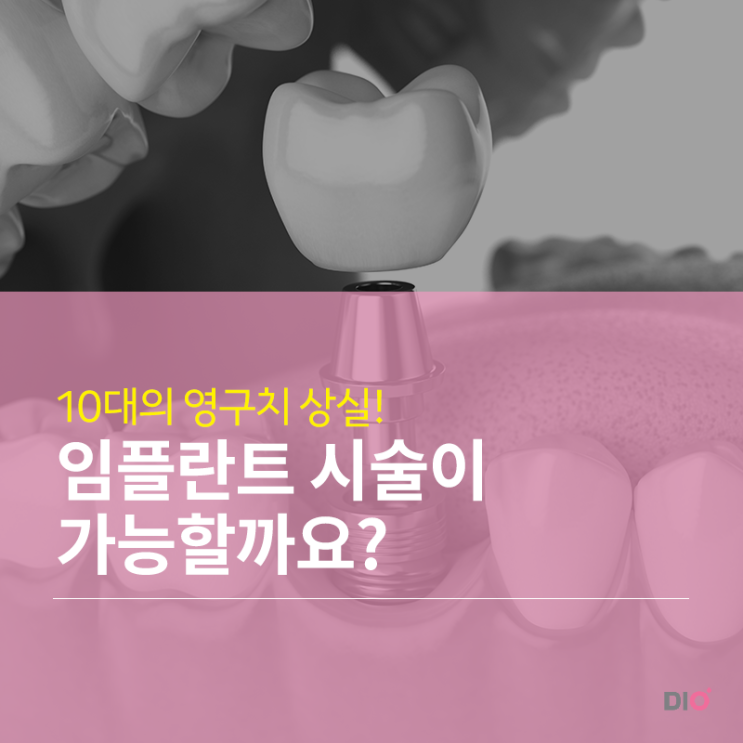  10대도 디오나비 시술이 가능할까요?