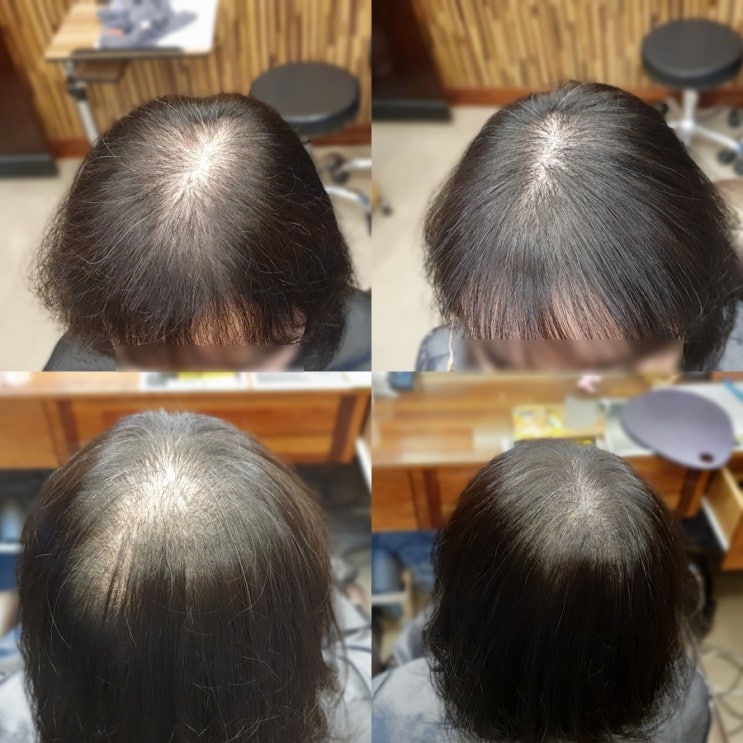  가르마 정수리 탈모 커버하러 헤어증모술 전문점 이진헤어 방문
