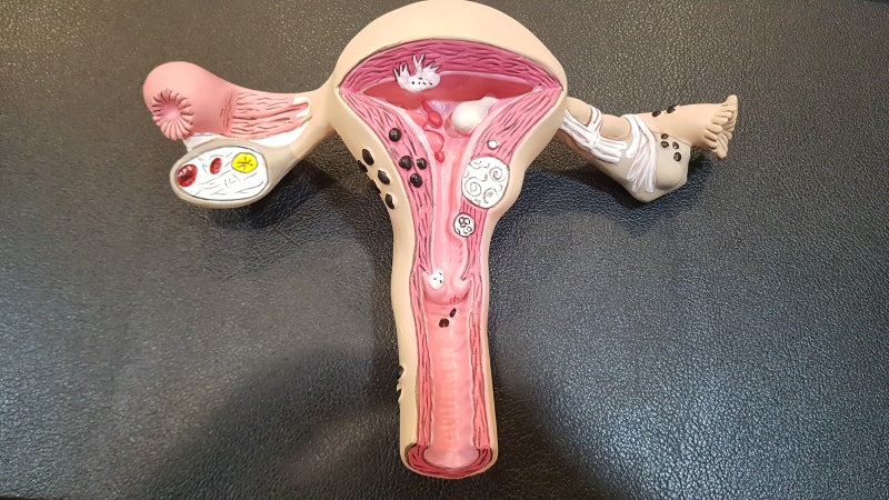 세균성 질염, 항생제 사용을 멈추려면 유산균 치료!!