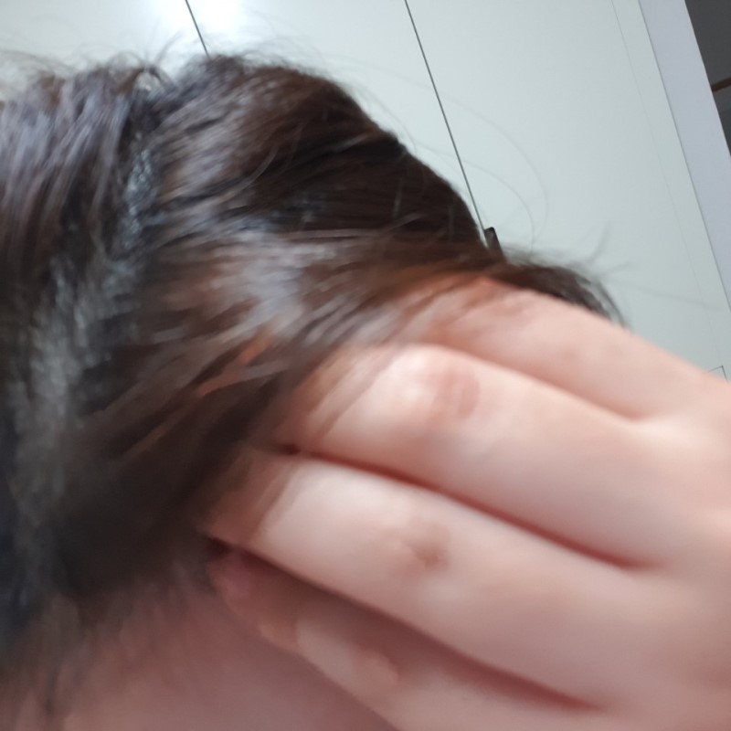 두피여드름 머리 여드름 증상 (리얼후기) : 네이버 블로그