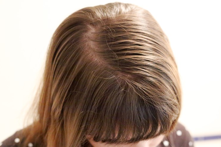 얇은, 연모화된 머리카락을 다시 두껍게 만들어줄 수 있는 방법?