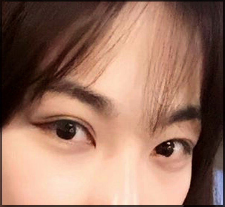  압구정앞트임재건수술 흉터 없이 복원