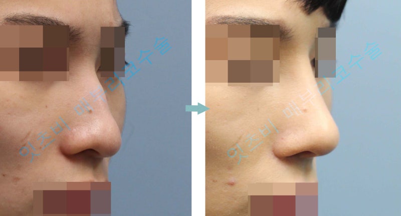 남자 매부리코수술로 비중격만곡증 수술과 복코 코끝성형까지 한 경우 : 네이버 블로그 남자 매부리코수술로 비중격만곡증 수술과 복코 코끝성형까지 한 경우 : 네이버 블로그