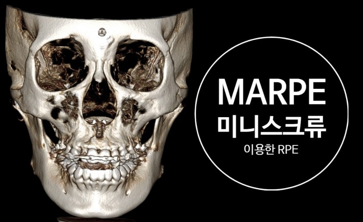 성인에서도 구개확장이 가능한가요? MARPE(miniscrew assisted RPE) or SARPE(surgically assisted RPE) 성인에서도 구개확장이 가능한가요? MARPE(miniscrew assisted RPE) or SARPE(surgically assisted RPE)