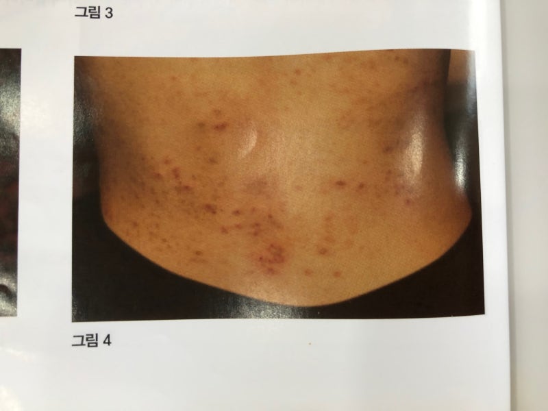 피부지랄, 원인불명 얼굴 알러지 4