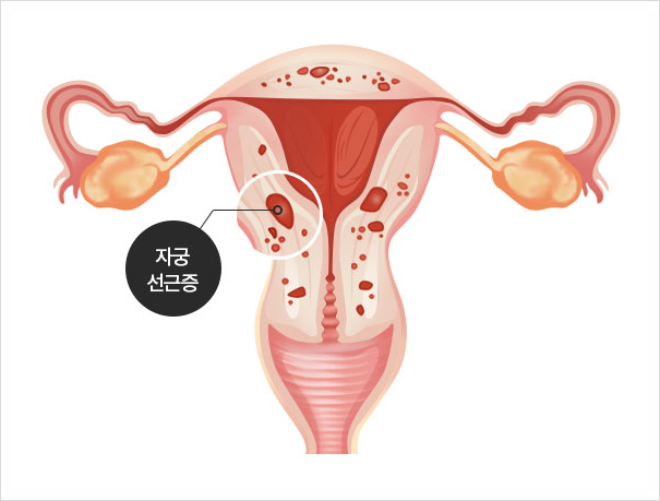 자궁선근증 자궁 적출은 필수가 아닙니다.
