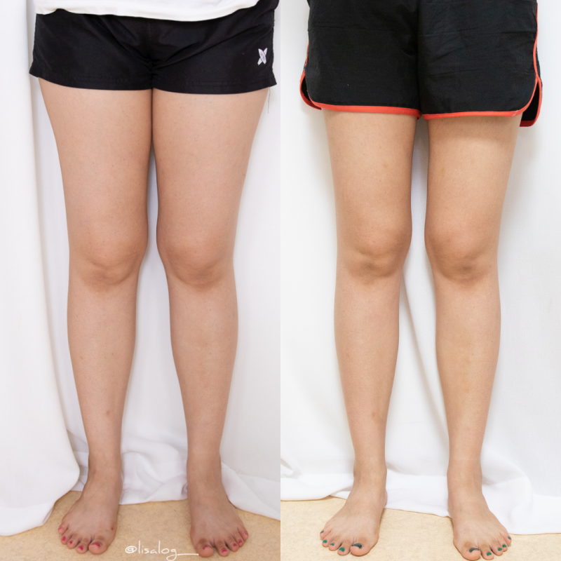 다이어트 주사 혼자서는 어려운 허벅지 다이어트 효과가 있었어요.