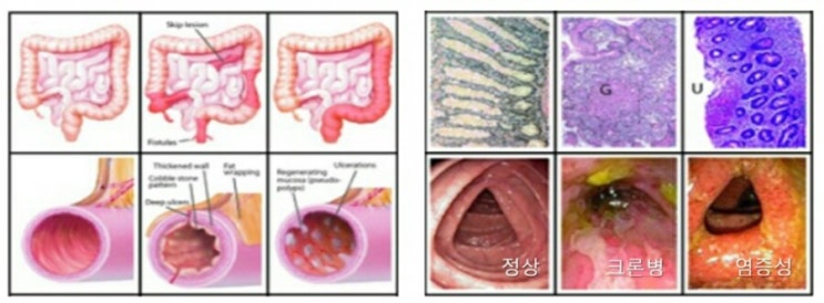 크론병 및 궤양성 대장염을 포함하는 염증성 장질환에 효과적인 포스트바이오틱스!