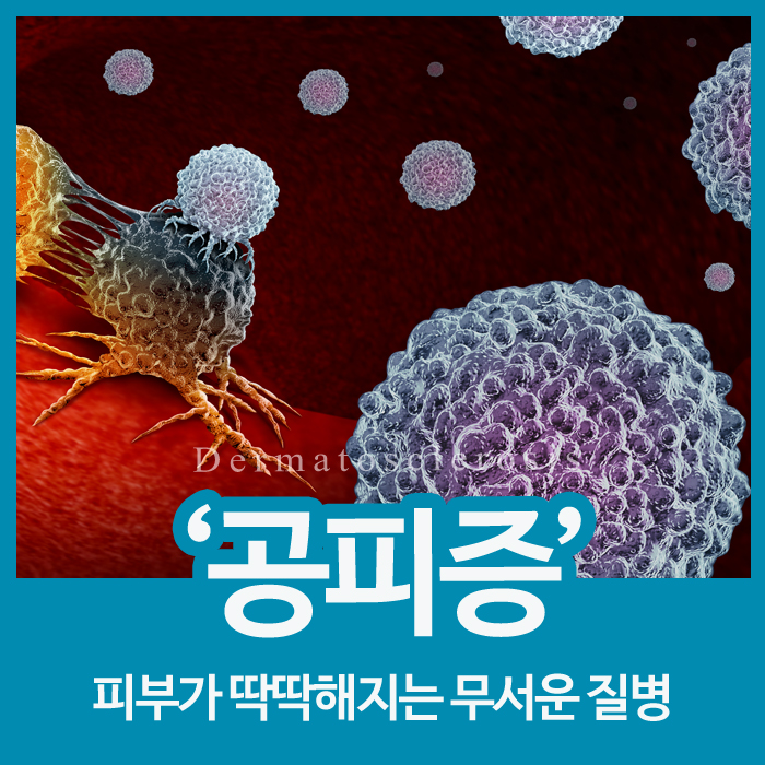  피부가 딱딱해지는 공피증의 증상, 유의해야 할 것은?
