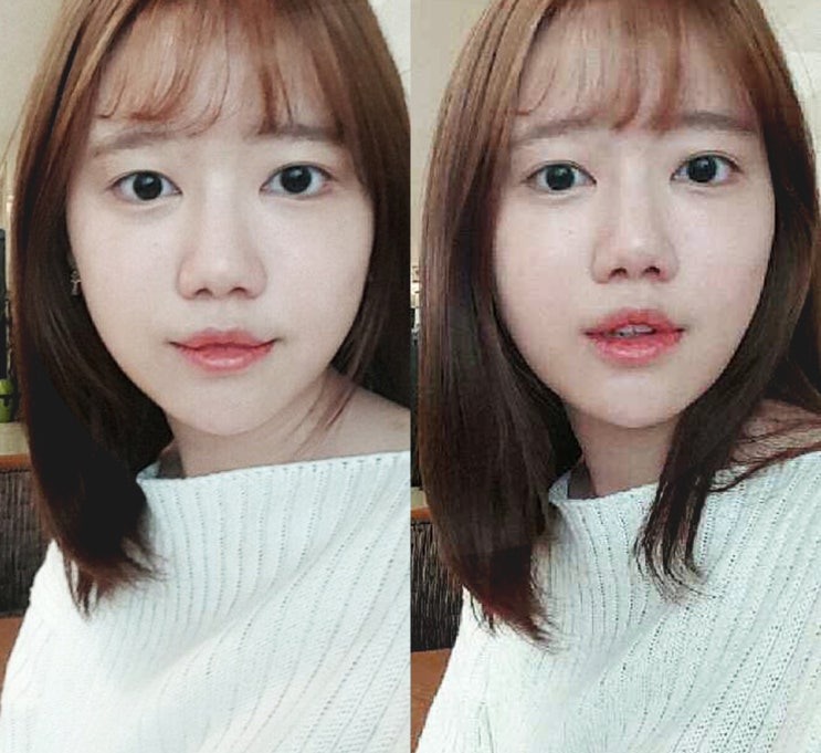 강남눈앞트임 크기 시원하게!