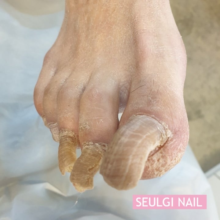 울산발톱무좀 NP케어 스켈링및 내성발톱케어로 깨끗한발관리