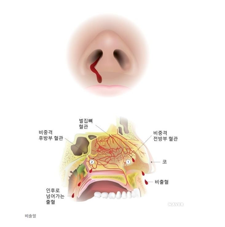 갑자기 코피가 자주 나는 이유와 코피 멈추는 방법 : 네이버 블로그