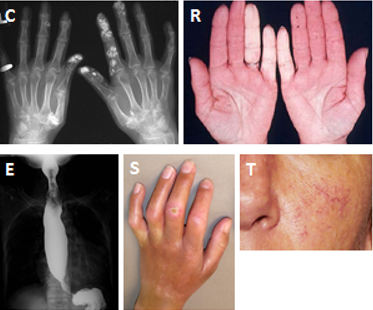 경피증(Scleroderma), 전신경화증(Systemic sclerosis, SSc) 정의 및 분류