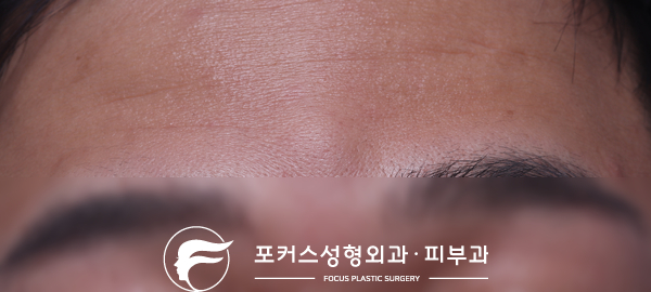  [부천성형외과 Dr. 김 칼럼] 미간의 혹