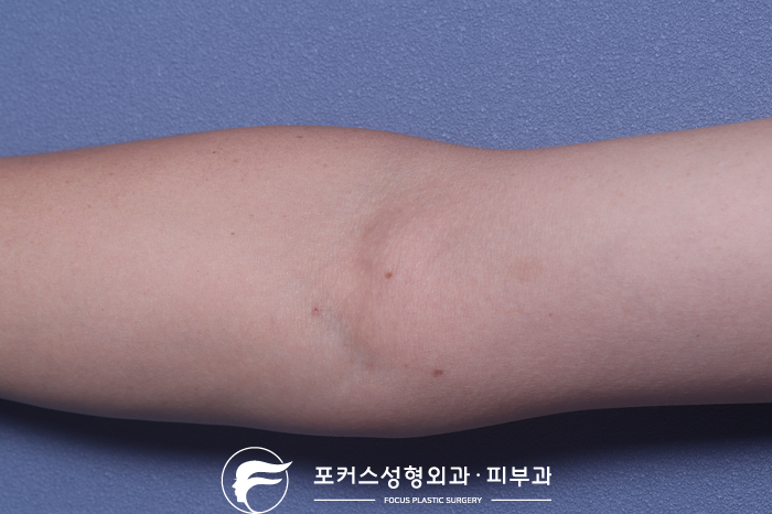  [부천성형외과 Dr. 김 칼럼] 오른쪽 팔의 혹