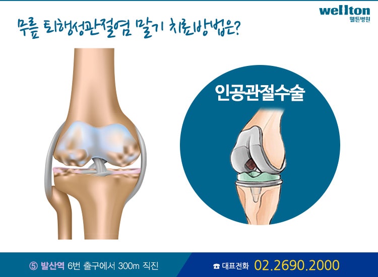 무릎 인공관절 수술. 합동 병원에서 정확히 말해주고 있습니다
