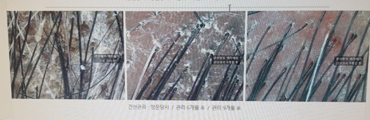  내 생애 최고의 선택? 건선관리를 받다 (2편)~'건선' 9개월 관리후기