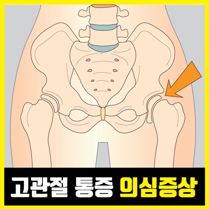 연신내재활의학과 고관절 통증 의심증상 양반다리 못하면..? : 네이버 블로그 연신내재활의학과 고관절 통증 의심증상 양반다리 못하면..? : 네이버 블로그